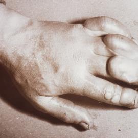 Atkinson's frost bitten hand